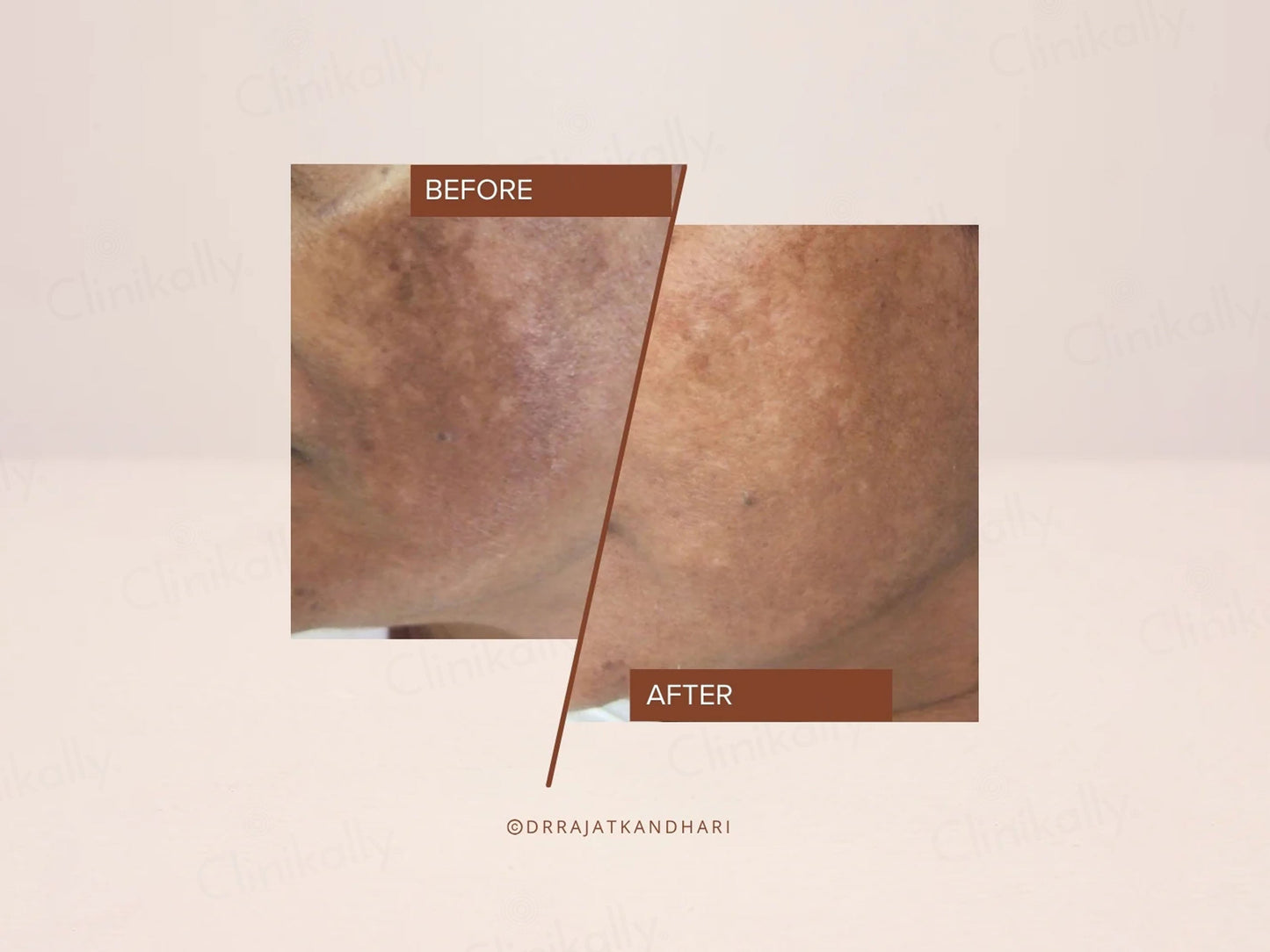 The Facecraft Project Exfoliate Brightening Smoothening Depigmentation Serum