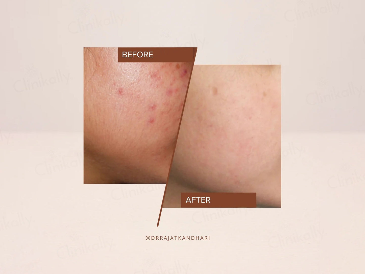 The Facecraft Project Exfoliate Brightening Smoothening Depigmentation Serum
