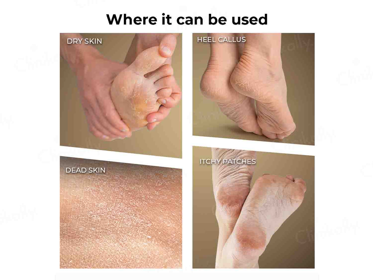 Winston Callus Remover